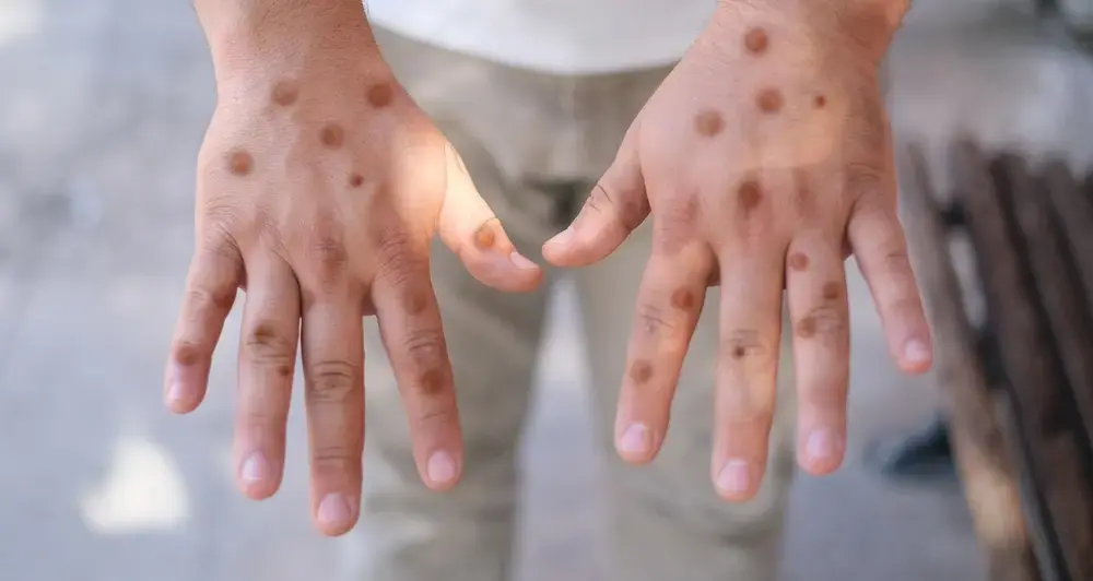 Monkeypox- Is a New Pandemic on the Horizon?